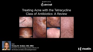 Treating Acne with the Tetracycline Class of Antibiotics A Review [upl. by Adaline]