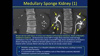 CT of Calyceal Abnormalities in the Kidney Pearls and Pitfalls  Part 1 [upl. by Onin]