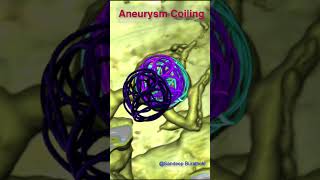 Brain Aneurysm Coiling [upl. by Sirotek]