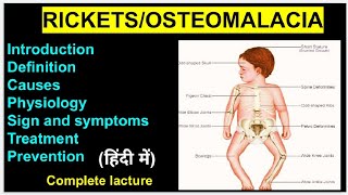 Osteomalacia  Rickets Disease Complete lacture In Hindi For Nursing GNM MBBS  Nursing Education [upl. by Jacquelyn985]