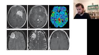 Oligodendroglioma  Resuminho rapidão [upl. by Aihsemak]