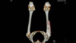 Subcapital femur neck fracture [upl. by Anitan]