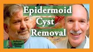 Epidermoid Cyst Removal INTACT Auburn Medical Group [upl. by Ulrika]