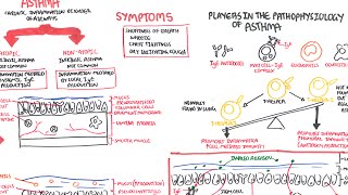 Asthma  signs and symptoms pathophysiology [upl. by Aigneis929]