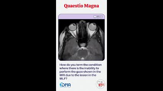 INTERNUCLEAR OPHTHALMOPLEGIA  OSPE amp OSCE  MBBS  NEXT   PLAB  USMLE  DMA [upl. by Komara]