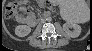 Malpositioned IVC filter penetrating vertebral body and aorta [upl. by Gunter89]