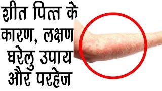 शीत पित्त UrticariaयाHives के कारण लक्षण घरेलु उपाय Effective Home Remedies For Hives [upl. by Novehs]