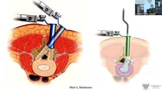 Traitement miniinvasif des hernies discales lombaires versant neurochirurgical [upl. by Ees972]