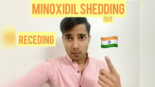 MINOXIDIL SHEDDING मिनोक्सिडिलMinoxidil Finasteride Results Receding Hairline Hairfall Hindi [upl. by Llenrahc]