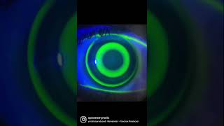 Orthokeratology for myopia control and treatment [upl. by Cummine177]