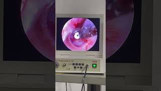 TTube Part3 hearingloss eardischarge tinnitus amazing [upl. by Ushijima]