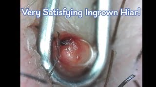 Heavily Infected Ingrown Hair Microscopic Removal WARNING BLOOD SHOWN [upl. by Swart815]