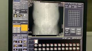 Intravenous Pyelogram I CECT KUB  CT Pyelogram CTU planning and procedure discoveryzsm7667 [upl. by Hedy]