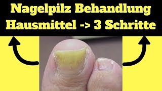 Nagelpilz Behandlung Hausmittel ✔ 3 Schritte um ekligen Nagelpilz loszuwerden [upl. by Marcel]