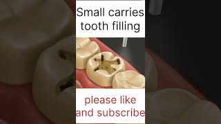 Small carries tooth filling asmr 3d localdentistry cavityfilling youtubeshorts ytshortsindia [upl. by Caron]