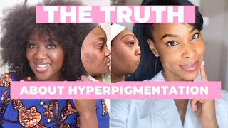 The TRUTH about Hyperpigmentation and Black Skin [upl. by Alegnat]