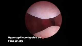 Hysteroscopie Polype piégé par une synéchie [upl. by Aneba447]