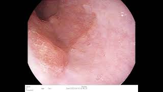 Tubular adenoma with high grade dysplasia cardia of stomach [upl. by Doretta]