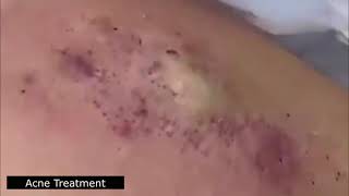 BEST BLACKHEAD AND WHITEHEAD REMOVAL SEVERE ACNE TREATMENT  SATISFYING AND RELAXING VIDEO [upl. by Man692]