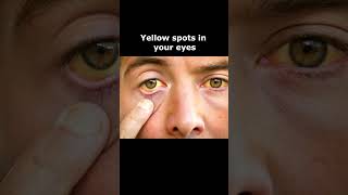 What Your Eye Symptoms May Mean  Yellow [upl. by Iand]