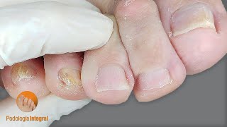 Fallen metatarsus  plantar corns and calluses  Affected skin and toenails  Comprehensive Podology [upl. by Arihs]