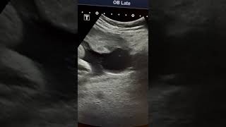 Placental cyst Ultrasound in 3rd trimester pregnancy ARDMD sonography [upl. by Mailiw]