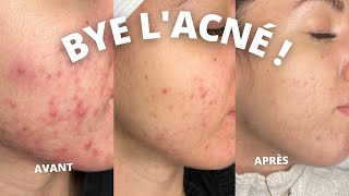 COMMENT SE DÉBARRASSER DE LACNÉ  MA ROUTINE SKINCARE [upl. by Odraccir983]