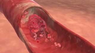 Stent Implant Procedure  Cardiac Animation [upl. by Aleahpar862]