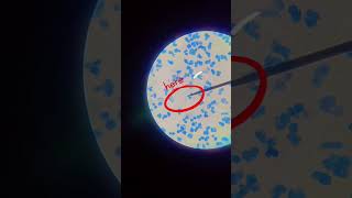 Mycobacterium tuberculosis in acid fast bacilli 🦠 [upl. by Amuwkuhc282]