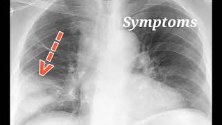 Lobar pneumonia  Symptoms Treatment and prevention [upl. by Hudis]