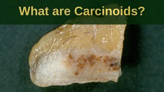 What are Carcinoid Tumours  Pathology mini tutoriaL [upl. by Eelsel]