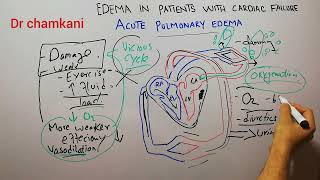 CVS 222  Pathophysiology of acute pulmonary edema  Edema in patients with cardiac failure [upl. by Misha716]