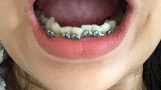 Timelapse 1 year Before and After Braces lower Shorts braces [upl. by Col555]