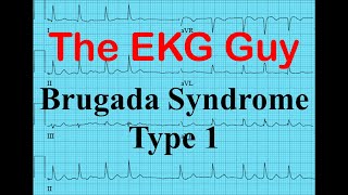 EKGECG  Brugada Syndrome Type 1  The EKG Guy  wwwEKGmd [upl. by Regine203]