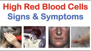 High Red Blood Cells Polycythemia Signs amp Symptoms amp Why They Occur [upl. by Intisar]