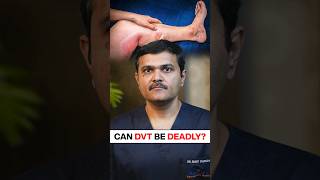 Can leg swelling be FATAL bloodclot shortvideo [upl. by Wyn]