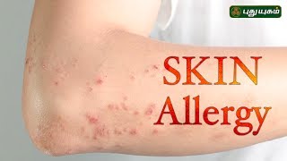 Skin Allergy  Hives  Morning Cafe  06072017  Puthuyugam TV [upl. by Blen]