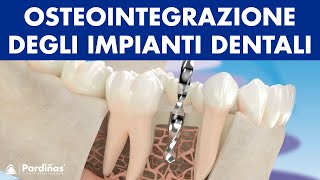 Le osteointegrazione degli impianti dentali © [upl. by Hultgren]