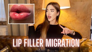 3 Things You Must Know To Avoid Lip Filler Migration  Causes amp Prevention [upl. by Cecilia]