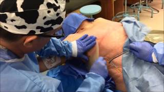 Securing a Chest Tube with a Halo Chest Seal [upl. by Samira]