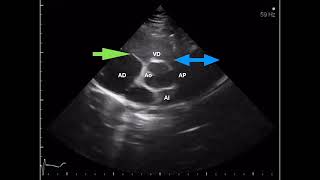 Ecocardiografía básica Tema 1 Planos ecocardiográficos [upl. by Neerhtak]