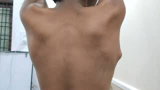 Osteochondroma Scapula  Very Interesting Case Dr Sai Chandra MBBS DNB Ortho [upl. by Frame225]