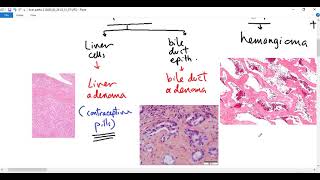 Systemic pathology 76  Liver tumors Dr Sameh Ghazy [upl. by Roinuj]