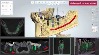 3D BioCAD  3Shape Implant Studio Step by Step Guide [upl. by Alf199]