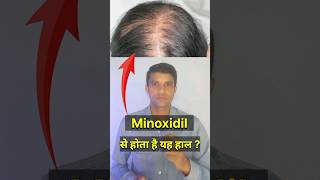 ☝️minoxidil लगाने से क्या होता है minoxidil hair growth results minoxidil side effects [upl. by Gavra]