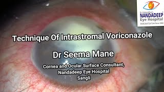 Intrastromal Voriconazole 50 µg01ml Dr Seema Mane [upl. by Amla]