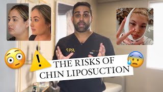 What are the RISKS of chin liposuction MUST WATCH BEFORE DOUBLE CHIN SURGERY [upl. by Nawyt]