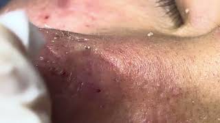 Acne treatment Thu 90 Da Nang  new 112024 [upl. by Eisler]