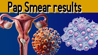 Pap Smear Results Explained under 3 minutes [upl. by Questa988]