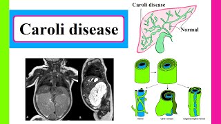 Caroli disease [upl. by Laurence661]